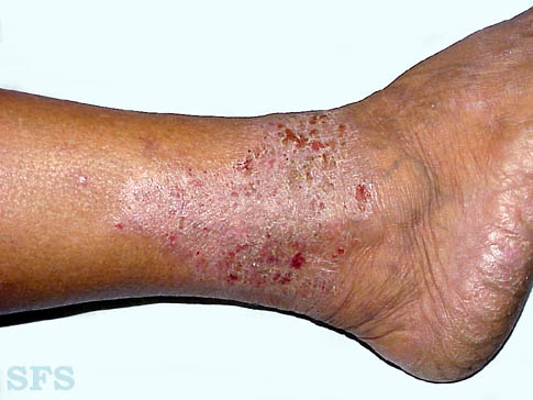 Skin Hardening Disease
